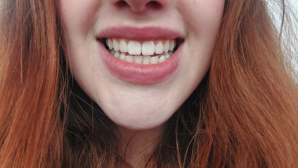 Whitewash Teeth Whitening