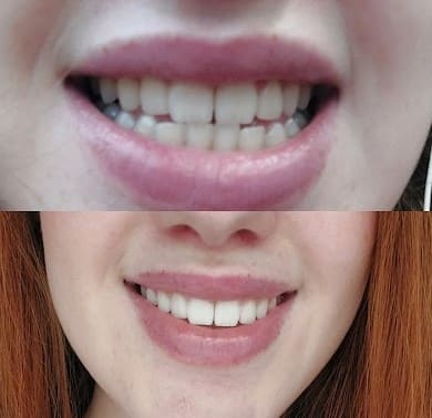 Teeth before and after.